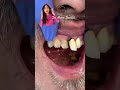 Broken crown, broken tooth - Dr.Massi Dental Clinic Broken crown, broken tooth