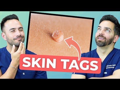 HOW TO TREAT SKIN TAGS LIKE A DERMATOLOGIST