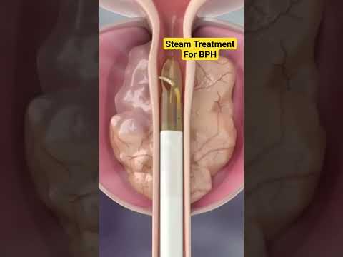 Treatments for Benign prostatic Hyperplasia   | Laser therapy for BPH |  TUMT | TUIP | Cystoscopy