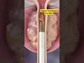 Treatments For Benign Prostatic Hyperplasia Laser Therapy For BPH TUMT TUIP Cystoscopy