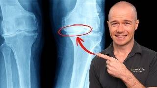The Truth About "Bone on Bone" Knee Osteoarthritis (& 3 Safe Exercises!)