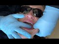 How To Find The Inferior Alveolar Injection Spot