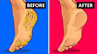 Home Remedy to Remove Cracked Heels Fast (Works Overnight)