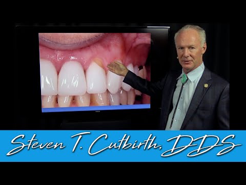 Abfraction on Tooth Colored Restorations