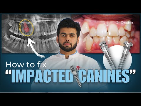 Impacted Canine Treatment Using TADs: Step-by-Step Orthodontic Guide