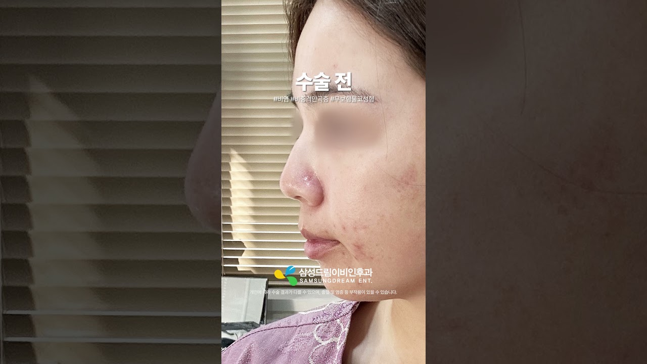여자 무보형물코성형 한달 후기👍 #shorts #비염수술 #비중격만곡증수술 #코성형 #비밸브재건술 #여자코성형 #코성형브이로그 #코성형후기 #코성형전후 #무보형코성형
