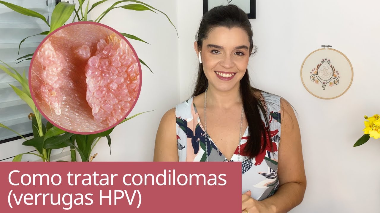 Tratamento para condilomas, verrugas causadas pelo HPV, verrugas genitais, vírus HPV