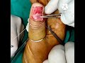 Glomus tumor excision