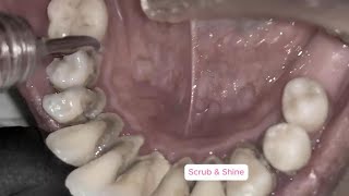 Can You Watch Till the End? Top 3 Most Impressive  Tartar Removals