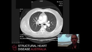 ECMO for massive pulmonary embolism – Prof Paul Forrest