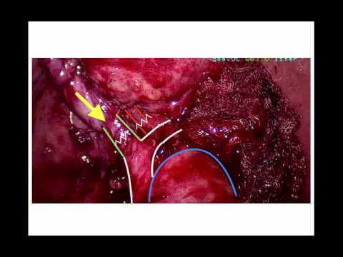 Explained The Laparoscopic Cholecystectomy Step-By-Step