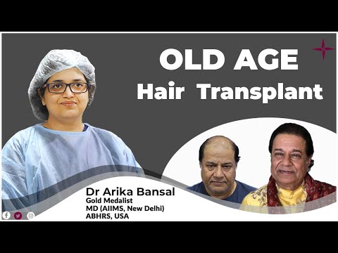 Excellent Hair Transplantation results for older age...