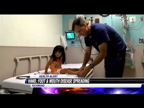 Area ER doctor warns Outbreak of Hand Foot and Mouth Disease