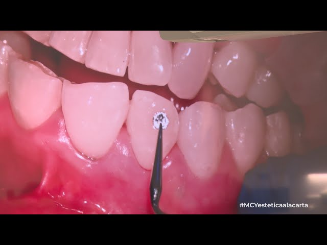 Vídeo relacionado con POPETPOP Adornos Para Dientes Decorativos Con Cristales Brillantes, 20 Piezas Blancas, Caja Almacenamiento Incluida, Accesorios De Joyería Para Mujer, Decoración Estética y Segura Para Sonrisa