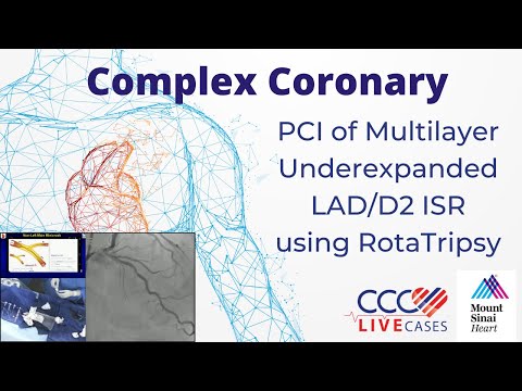 PCI of Multilayer Underexpanded LAD/D2 ISR using RotaTripsy