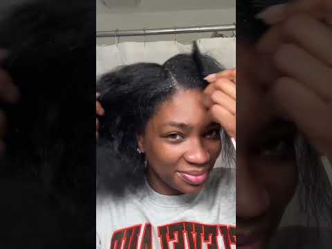 seborrheic dermatitis pt 7