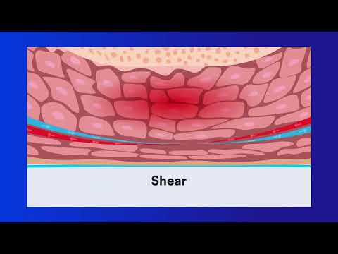 Pressure Injury Education: Chapter 2 Cause
