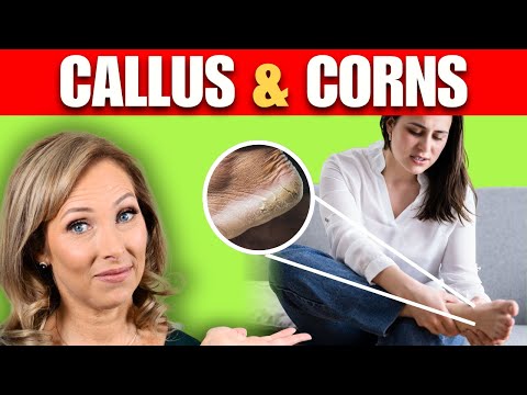 5 Tips For Calluses & Corns | Dr. Janine