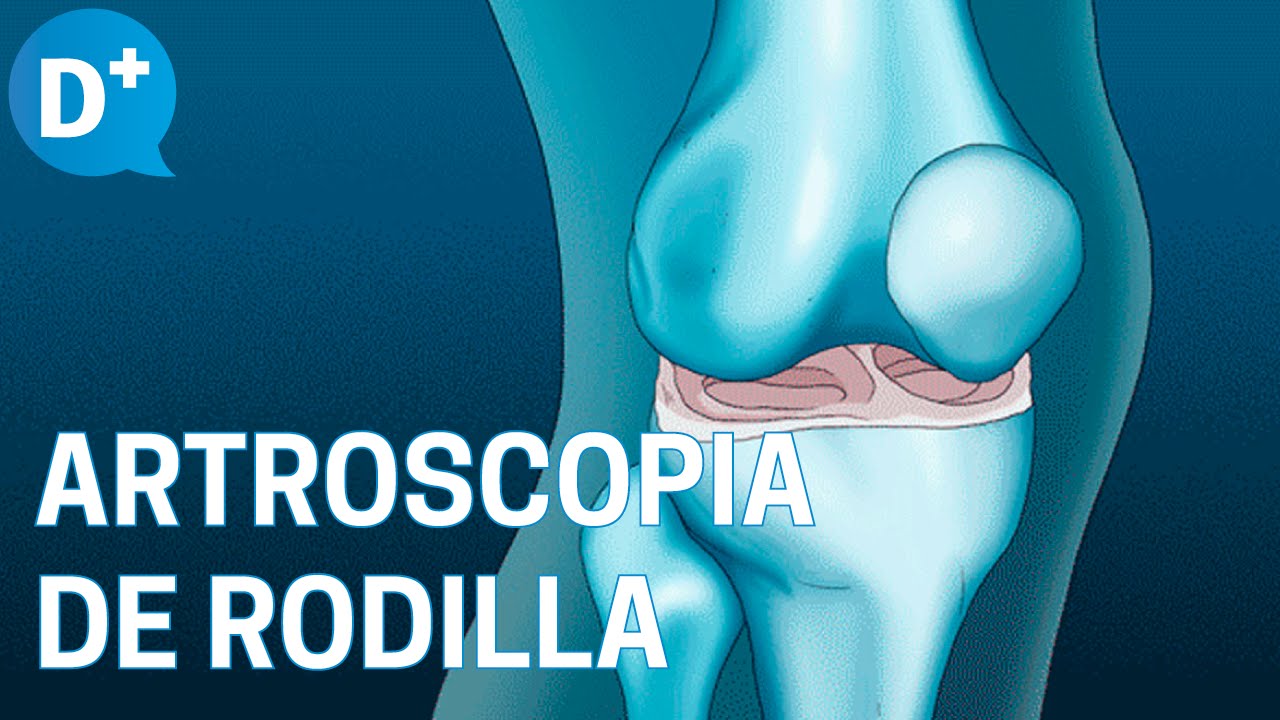 ¿En qué consiste la Artroscopia de rodilla