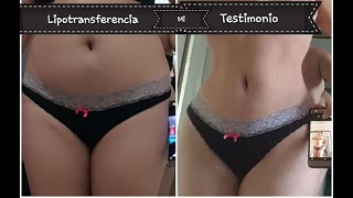 FOTOS de mi Antes y Despues. Bbl/Liposucción/Lipotransferencia Testimonio #Miralo hasta el final