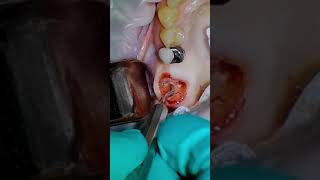 Extraction of a Tooth Step by step