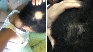 Growing Back My Bald Spot - How To Get Rid Of Bald Spots Fast! |  Natural Bald Spot Treatment