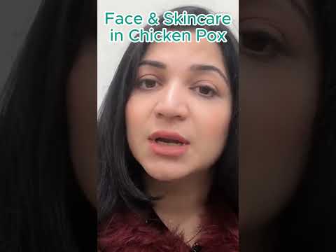 , title : 'Chicken Pox Face Care l Chicken Pox Skin Care l Face Skin Care l Important Task in Chicken Pox'