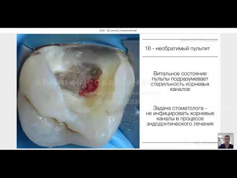 Лечение пульпитов постоянных зубов