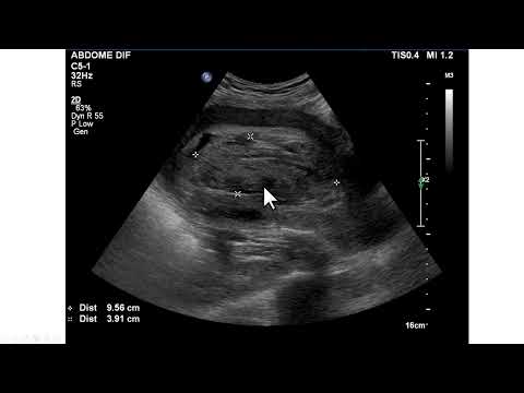 Hematoma na cavidade uterina após parto cesariana