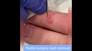 Wart Removal by Radiosurgery - Quick & Thorough Removal of Stubborn Finger Warts!