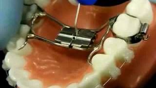 Bracesquestions.com - Orthodontic Jaw Expander, How to Turn