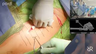 Dr. Stefan Kreuzer performing Direct Anterior Approach Total Hip Arthroplasty featuring STERIS