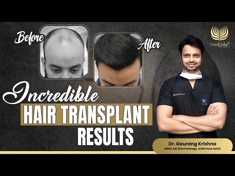 MedLinks Patient Hair Transplant Journey