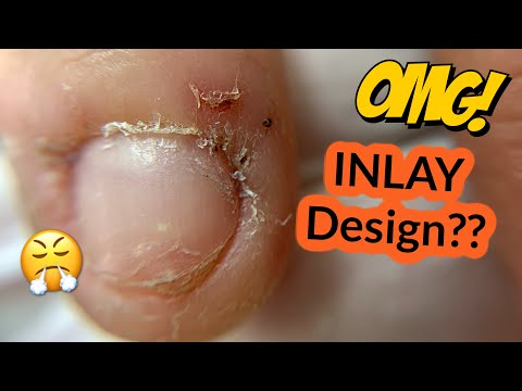 How to Fix a Severely Bitten Nails | Inlay Acrylic Design with Foil