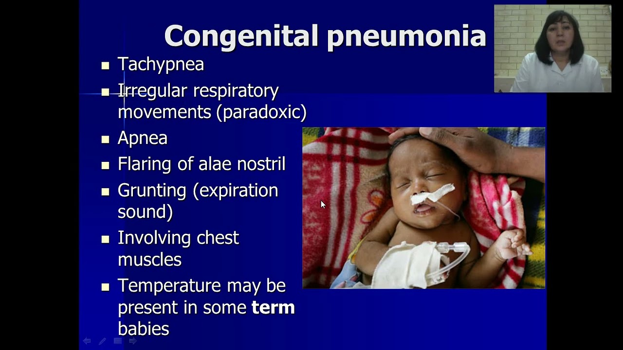 Pneumonia in children: etiology, diagnosis and treatment