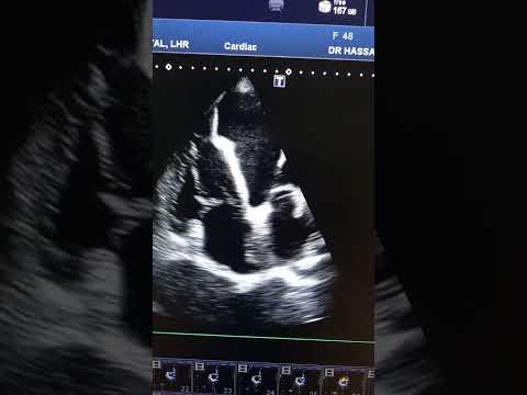 apical VSR#echo #fcps #echorouk