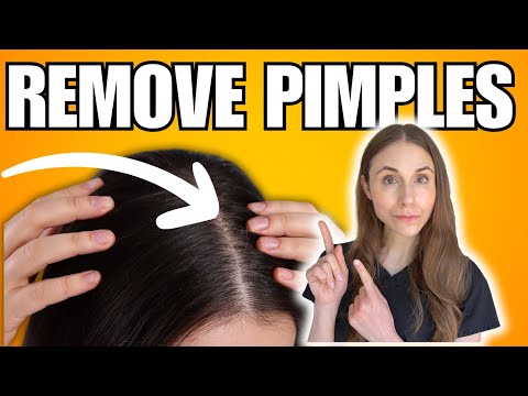How To Remove Scalp Pimples | Folliculitis Explained