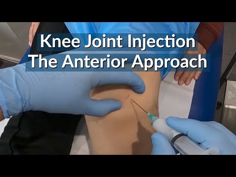 Knee Joint Injection : The Anterior Approach (eyes of the knee) - The most painless technique