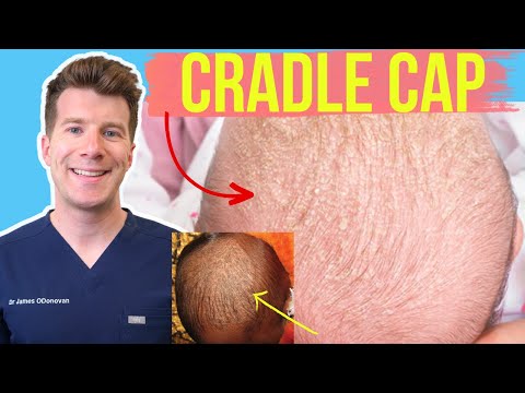 Doctor explains CRADLE CAP (Seborrheic dermatitis) in babies & infants | Photos and home treatment!