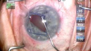 Malyugin ring insertion