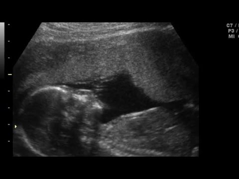 Baby Heartbeat at 21 weeks