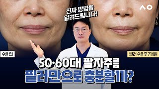 50–60대 팔자주름, 필러만으로 해결될까요? 연령대별 정확한 해결법!