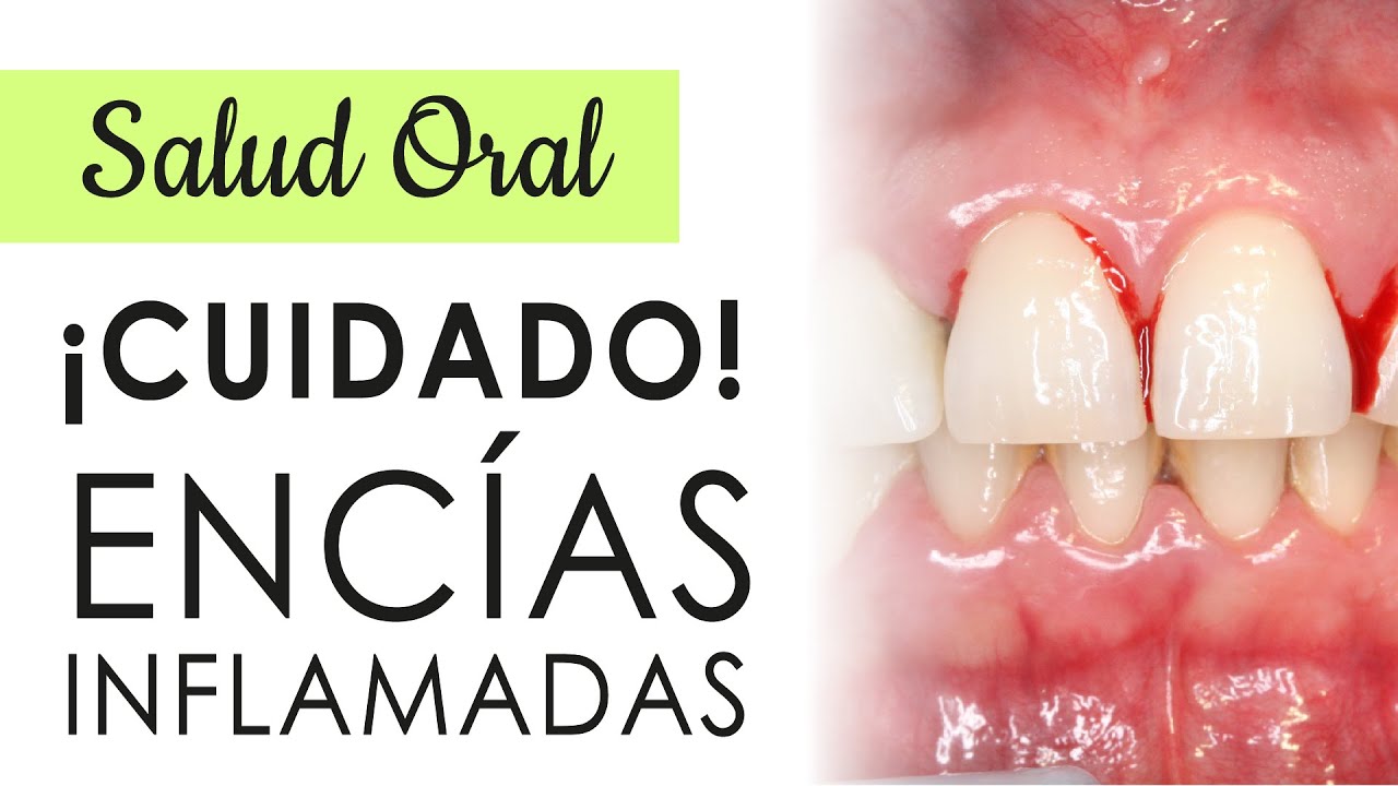 Watch ¡¡CUIDADO CON LAS ENCÍAS INFLAMADAS!! | CAUSAS Y TRATAMIENTOS Now ¡¡CUIDADO CON LAS ENCÍAS INFLAMADAS!! | CAUSAS Y TRATAMIENTOS