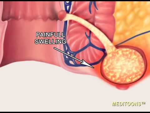 Anal Fistula - Meditoons™