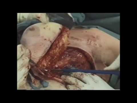 marCut® – Mastectomy