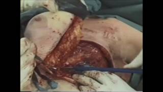 marCut® | Mastectomy