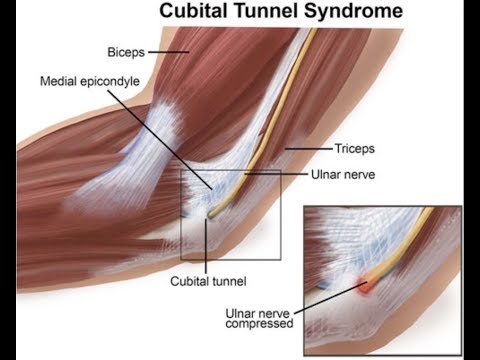 Hook Test For Distal Biceps Rupture
