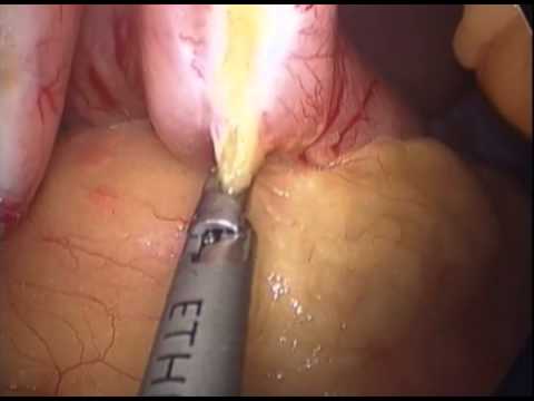 Rękawowa resekcja żołądka u pacjenta z odwrotnym ułożeniem trzewi