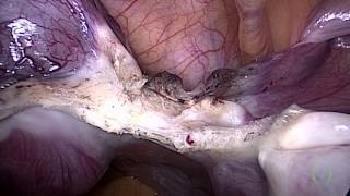A Rare Case of Rudimentary Horn Ectopic Pregnancy