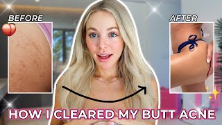 How to Get Rid of Butt Acne FAST | The TRUTH About How I Fixed My Butt Acne
